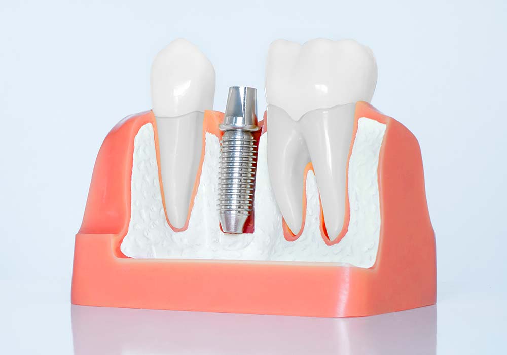 インプラント
